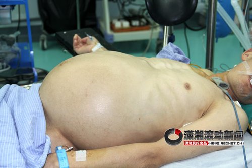 常德中年汉子肚大如孕妇 医生巧妙接生(图)_