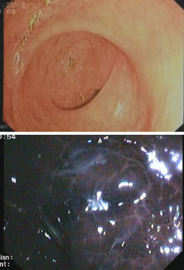 23岁女子肠镜照出黑蛇皮状