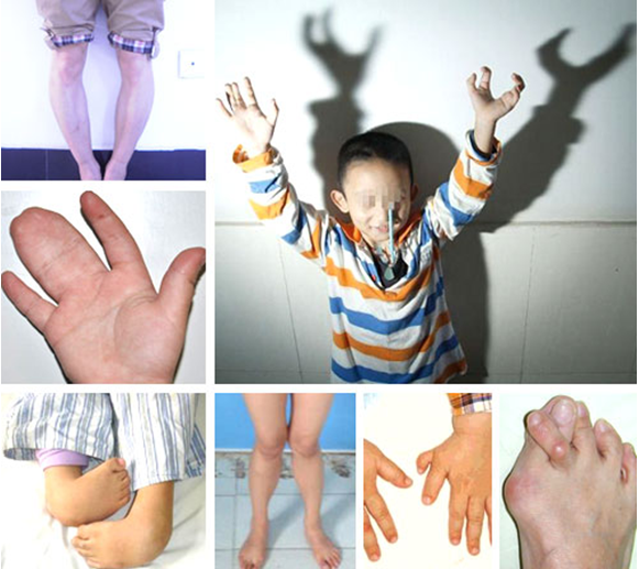 北京积水潭专家长沙亲诊 全省征集手足畸形患者
