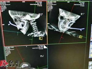 邵阳一4岁男童被铁钩钩进嘴 家长要加强看护