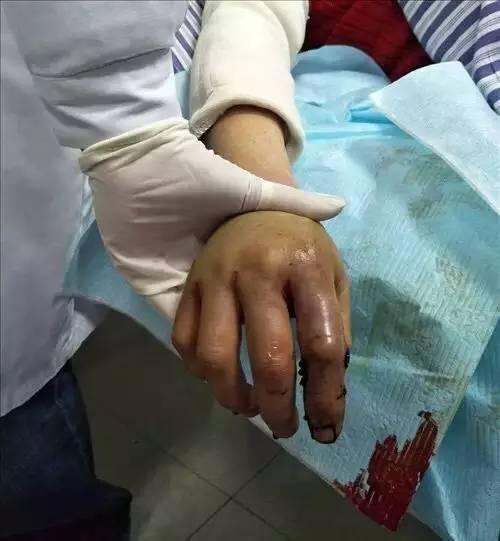 株洲一女子摘野菜被蝮蛇咬伤 右手手背肿胀发