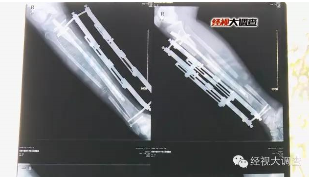 揭秘长沙断骨增高地下窝点 穿入钢钉拉伸断骨