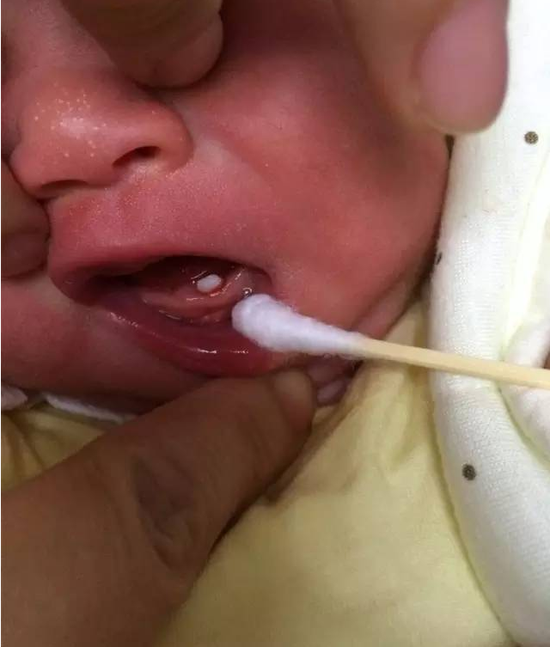 常德一婴儿出生嘴里就长牙 医生称从没遇到过