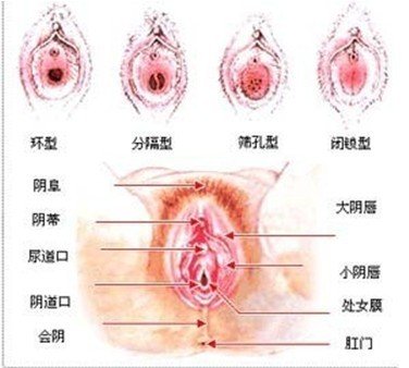 专家介绍:<em>处女膜</em>是覆盖于
