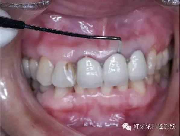 好牙依科普:烤瓷牙的危害