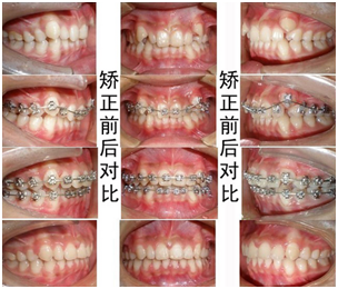 但是仍然有很多人不知道牙齿矫正需要经过哪些过程,有什么是在牙齿