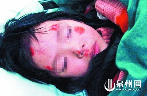 <em>幼女</em>被父亲打至骨折抛窗外