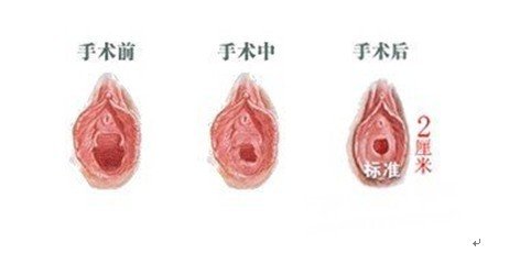 韩式venus无痛处女膜修复术七大特点