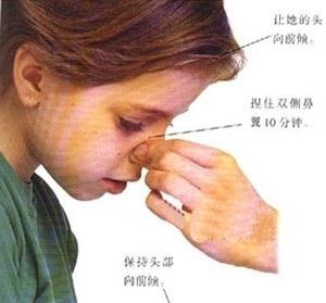 导致鼻出血的门诊,住院病人60余例;专家提醒:鼻子出血应该这样做