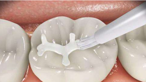 97%宝宝龋齿未治疗 宝宝龋齿可能会引发全身性疾病 _大湘网_腾讯网