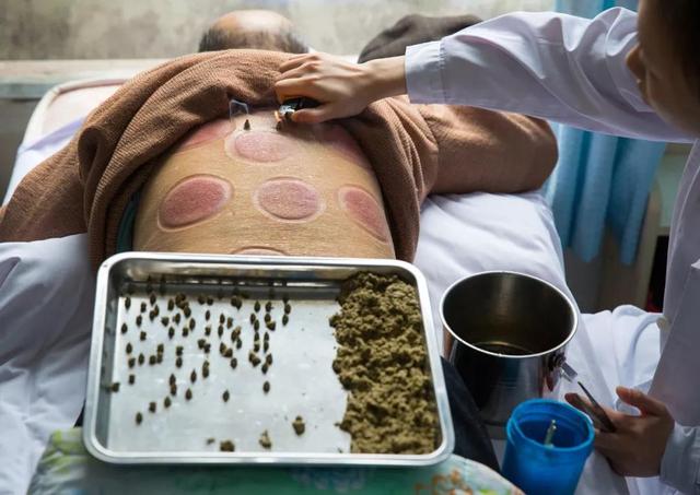 中医头部拔罐.