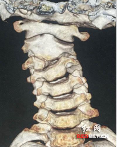 常德男孩颈椎罕见畸形 手术切除后已出院