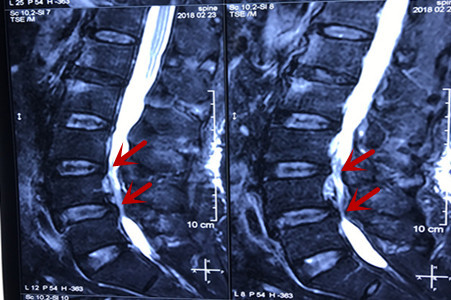 任性!长沙大爷疾病缠身 手术后逃出病房去喝