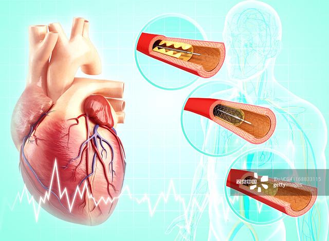 长沙94岁老人急性心梗获救 支架手术后的救命宝典你知道多少