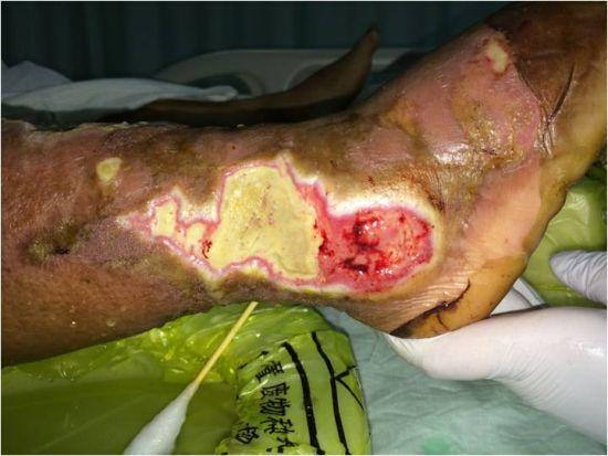 湖南农妇被公鸡啄伤多器官功能衰竭 祸因是糖