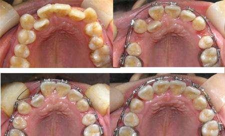 如儿童的吮指,口呼吸等,可造成牙弓狭窄或影响颌骨发育,而导致牙齿