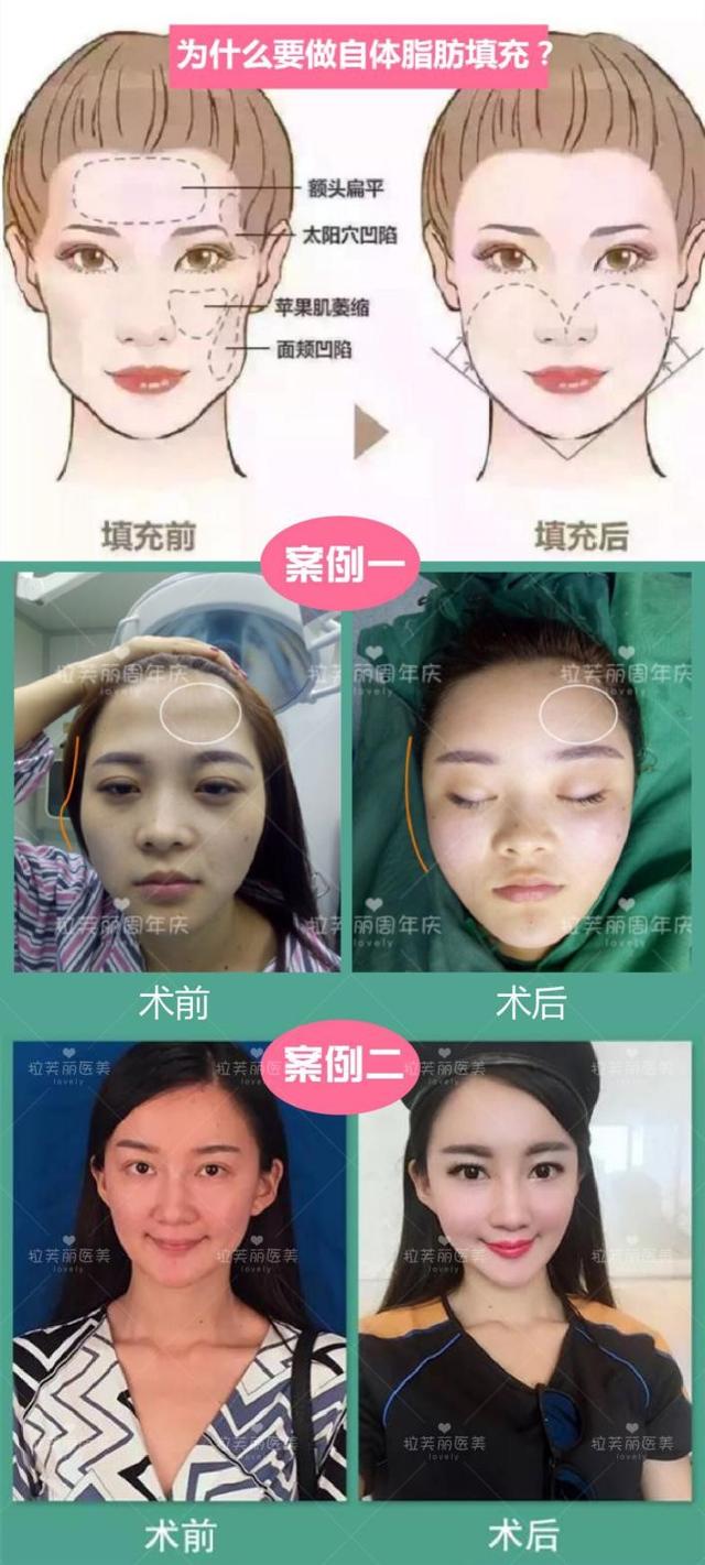拉芙丽抗衰老的软黄金--自体脂肪填充 千万不能浪费_大湘网_腾讯网