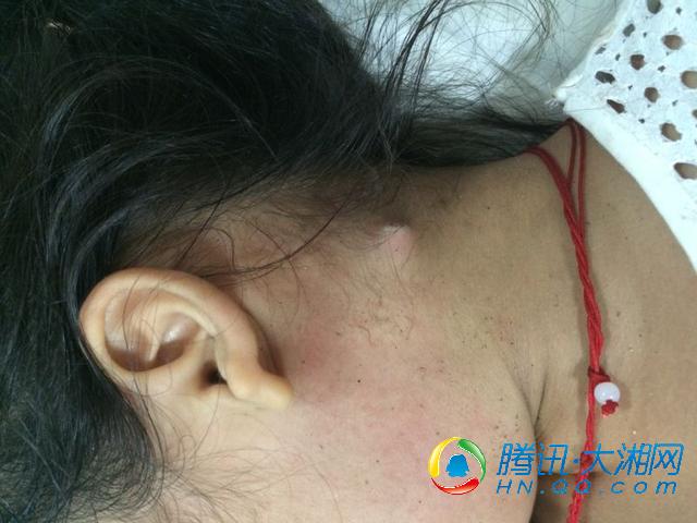 9岁留守女童骑车摔倒 竹棍插入颅底