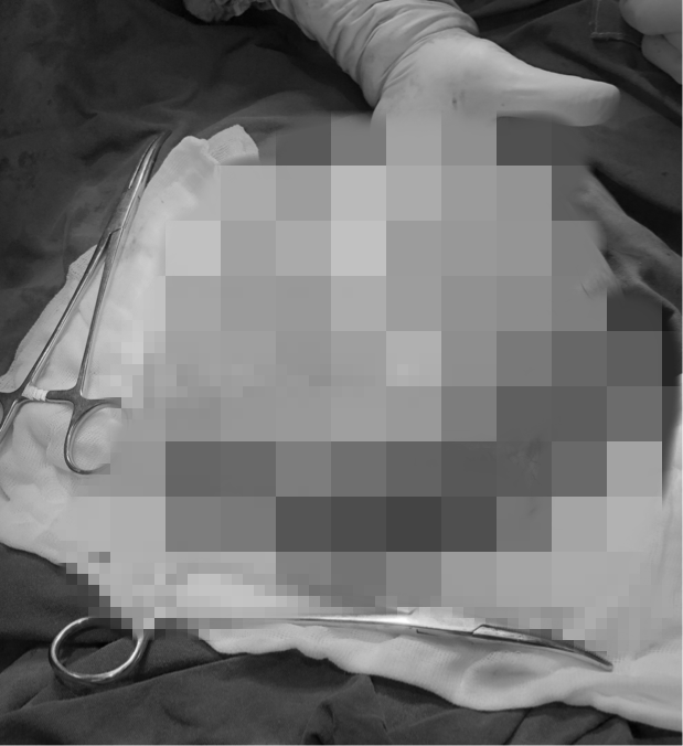 湖南19岁女孩月经不规律 医生从盆腔中取出婴