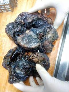 烟龄40年的老烟枪肺黑成炭 每天至少抽两包!