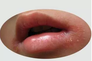 扬州10岁男孩不停舔嘴唇 舔到出血发黑嘴角糜