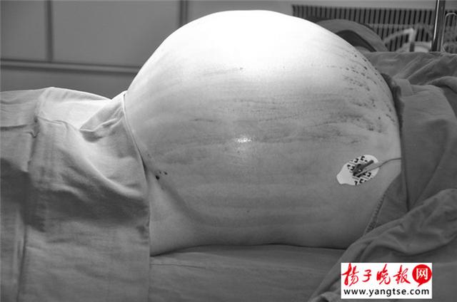 女子长了40斤"超级肿瘤" 以为怀了三胞胎