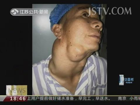 巨大肿瘤 被成功切除  来自安徽的郑先生,起初脖子上一个不起眼的肿块