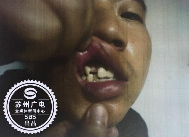 快递小哥与宝马车主起冲突 被打掉半截牙齿