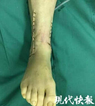 男子被狂风从货车上扫落 骨折多处被植入7块钢板