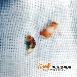 徐州一男子鼻腔里长出两颗牙齿 原是恒牙胚错