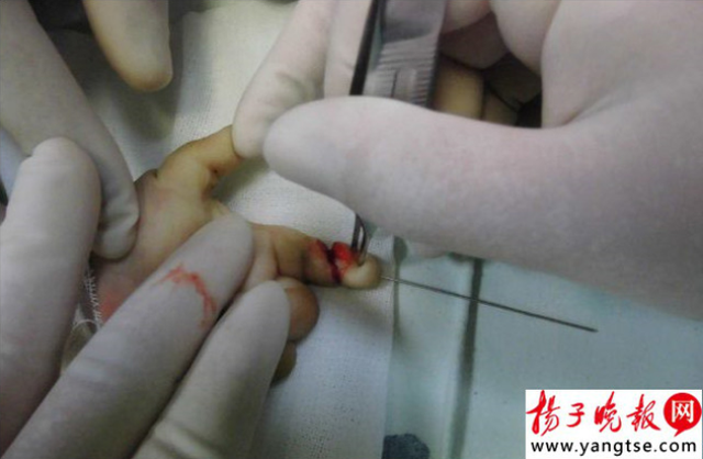 就直接用剪刀裁剪起来,没想到她居然不小心剪掉了宝宝的一截手指