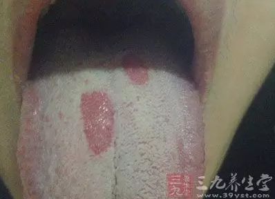 舌头出现这症状可能得癌症 常咬舌头也是病