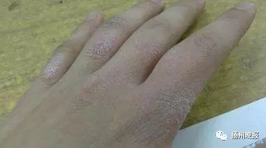 扬州一女子皮肤干燥瘙痒 检查发现是糖尿病