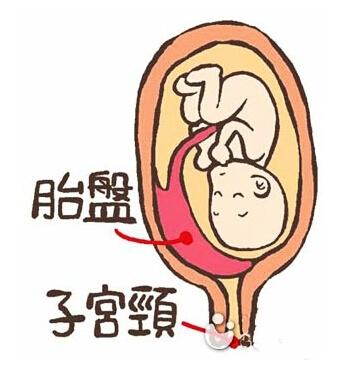 孕妇二胎胎盘“长”在子宫上 差点造成大出血 _大苏网_腾讯网
