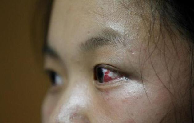 15岁女生被女同学群殴一小时 眼睛充血浑身是伤