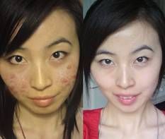 昔日痘妹分享成功抗痘锦囊