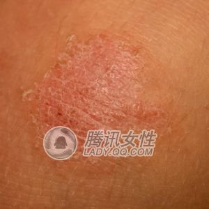乳腺癌会表现在乳房的皮肤上,比如乳头或乳晕处出现表皮糜烂,湿疹等