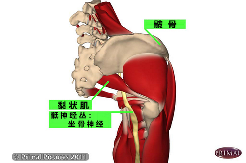 梨状肌示意图.; 挤压综合征;; 是什么原因导致坐骨神经痛?