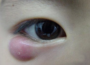 眼睛干涩瘙痒 到底得了什么病