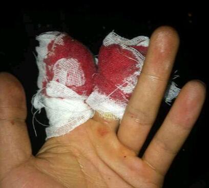 男孩两根手指遭机器链条夹断 辗转四家医院得