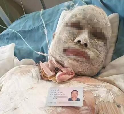 点根烟家里突然爆炸 丈夫烧成"无皮人"妻子重伤_大辽网_腾讯网
