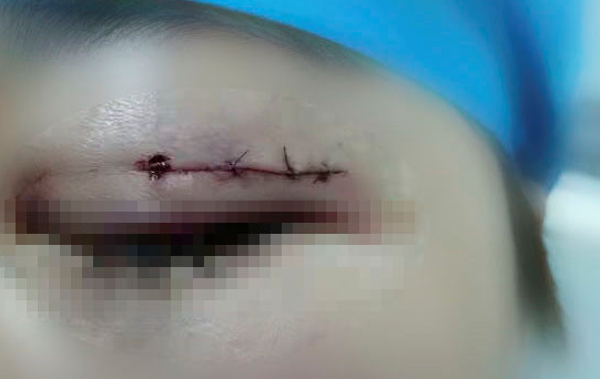 女子做双眼皮手术时 美容针折断在眼眶内