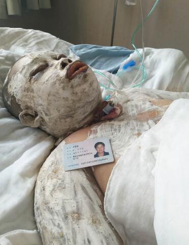 男子点烟家里突然爆炸 夫妻俩大面积特重度烧伤