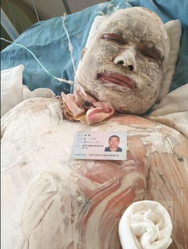 男子点烟家里突然爆炸夫妻俩大面积特重度烧伤