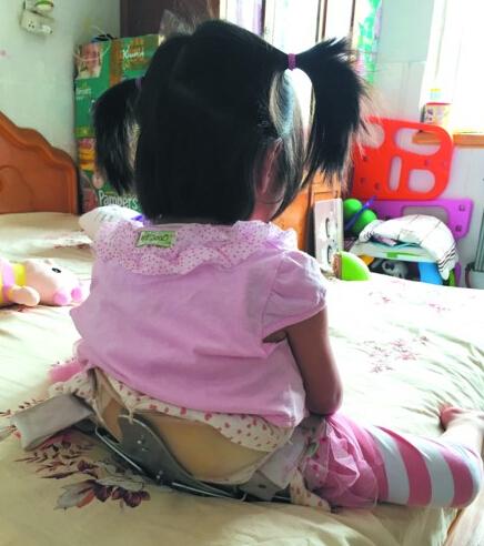 4岁女孩髋关节畸形 6岁前不手术恐无法再走路