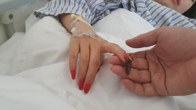 女孩滑雪因美甲拽断两节手指 3小时手术未能再植