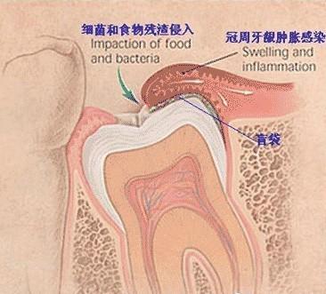 智齿冠周炎:一种破茧不能成蝶的\痛\