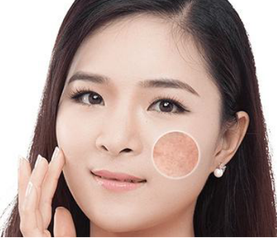 脸上长色斑怎么回事?怎样去除脸上的色斑