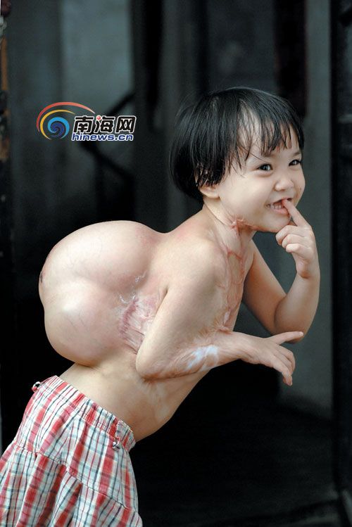 站立时明显驼背 残疾女孩急需做二期手术_海南