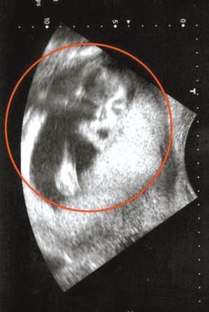 英国胎儿b超显示长有杰克逊脸(图)